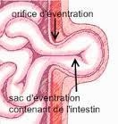 Schéma d'une éventration